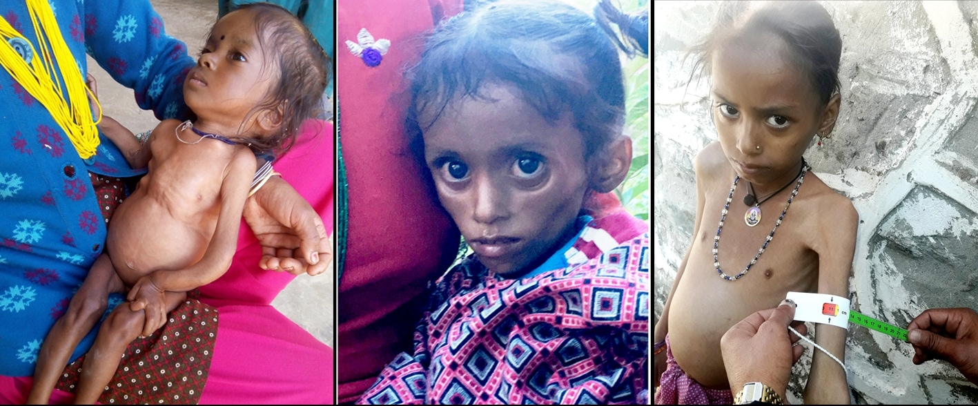 Malnutrition in Bajhang: Daughters at greater risk